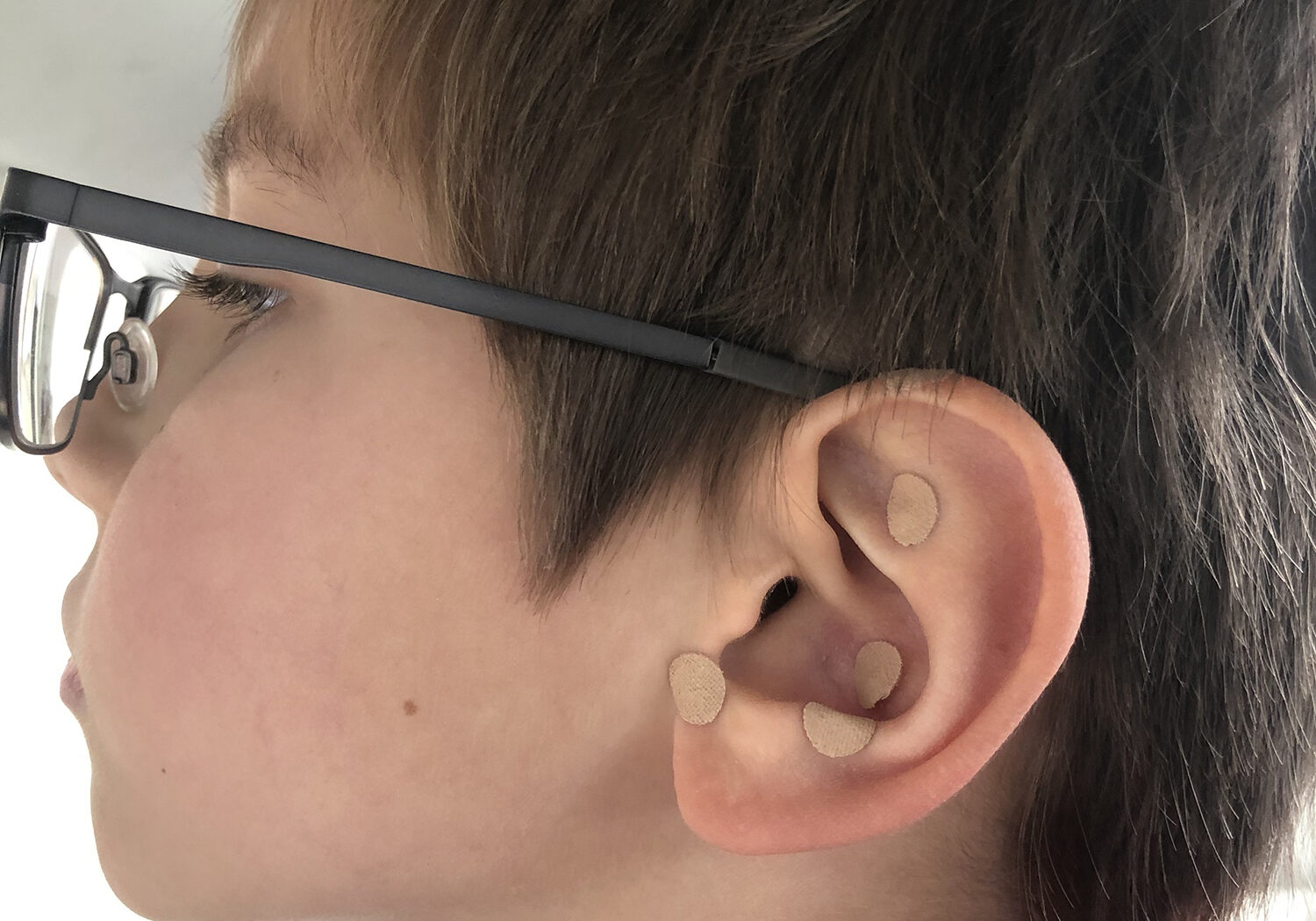 kiddo auricular acupuncture